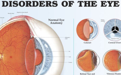 Disorders Of The Eye Infographic F