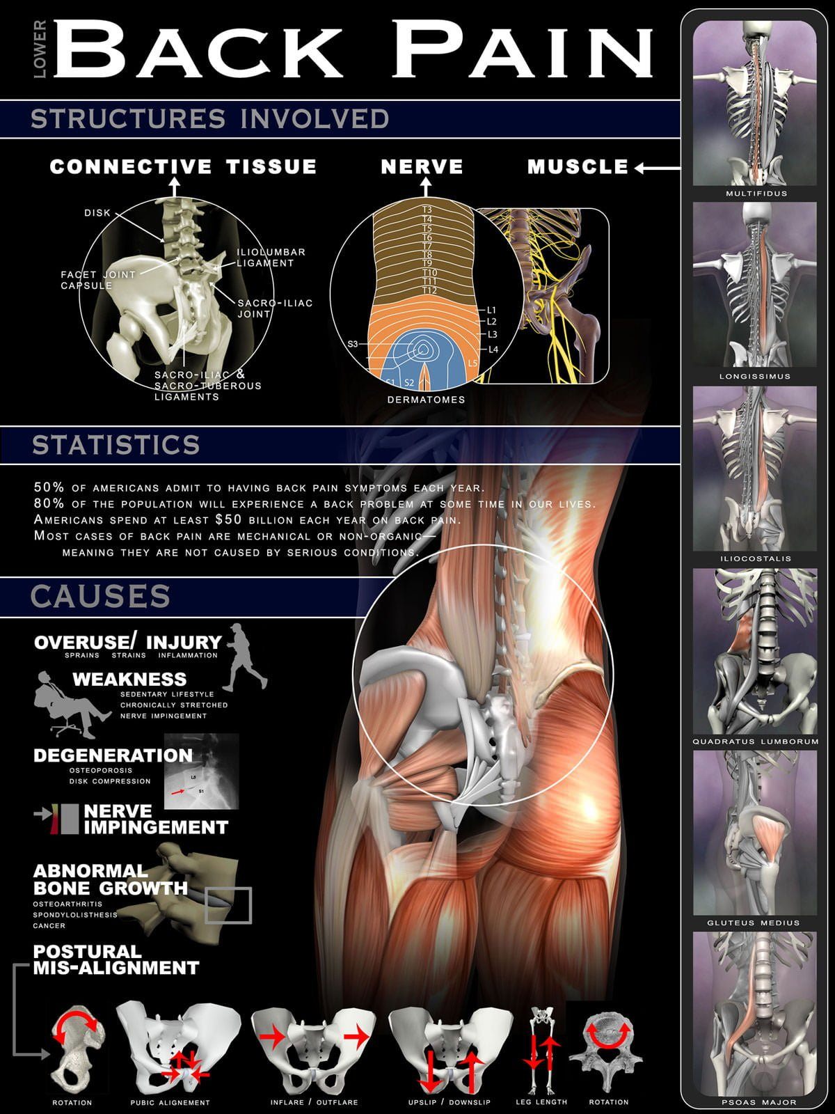 Lower Back Pain Infographic