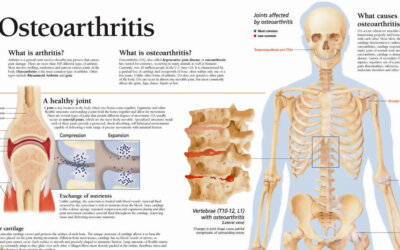 Osteoarthritis Anatomy Chart F