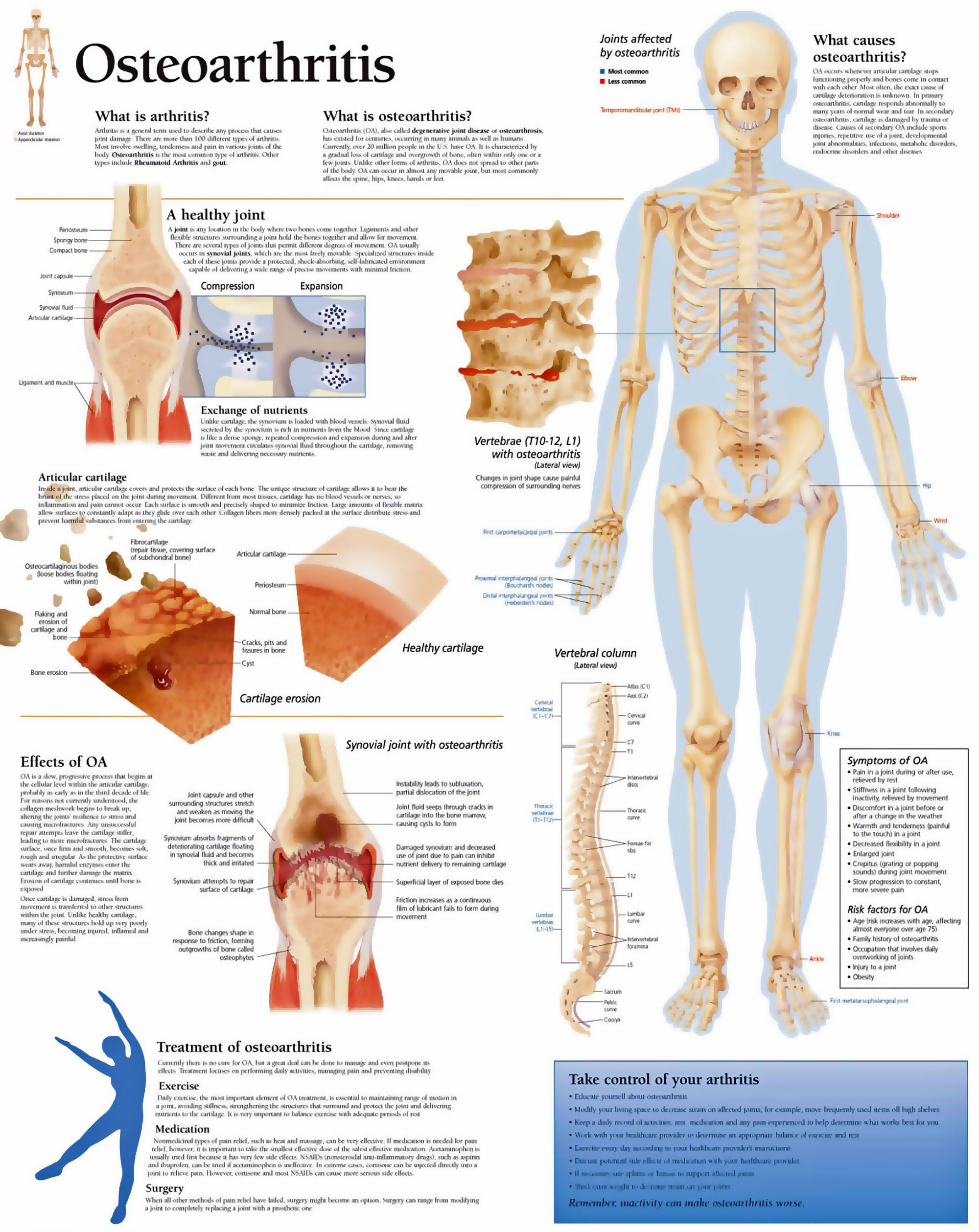 Osteoarthritis Anatomy Chart