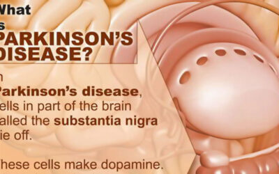 Parkinsons Disease Infographic F