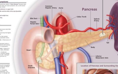 Understanding Pancreatic Cancer Chart F