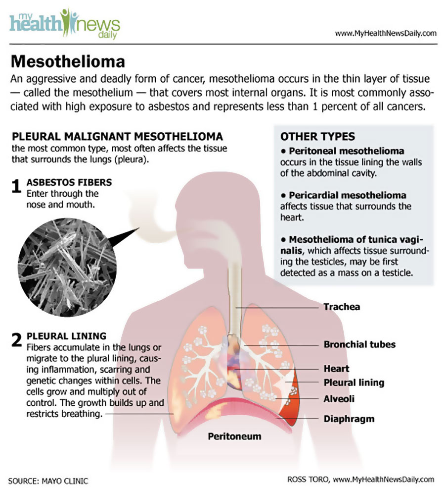 Mesothelioma Infographic
